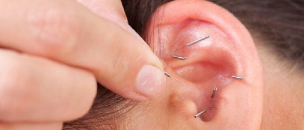 Auricular Acupuncture